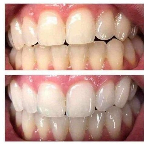 I’m so excited 😝I just started mine so I will be sharing my own before and after results pictures soon !! Whitening Toothpaste 💫 Why pay a fortune for teeth whitening when you can get these results from using the whitening toothpaste ? 🤯 Whitening, fluoride toothpaste polishes and brightens your teeth for a healthy-looking smile. Leaves your mouth with a cool, clean, and fresh feeling. Natural flavors and ingredients to help protect and maintain your best oral hygiene.safe for all ages ... Teeth Whitening Remedies, Teeth Whitening Diy, Natural Teeth Whitening, Whitening Toothpaste, Natural Teeth, Fresh Feeling, Oral Hygiene, Teeth Whitening, Natural Flavors