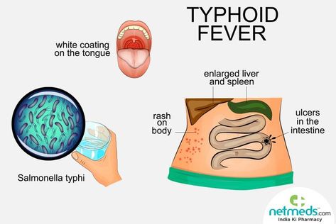 Typhoid Symptoms, Plant Cell Parts, Enlarged Liver, Fever Symptoms, Cell Parts, Plant Cell, Practice Management, Bacterial Infection, Nursing Notes