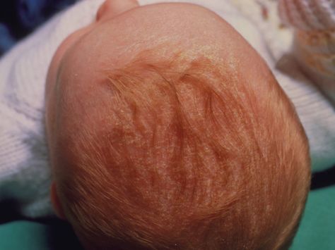 cradlecapphoto_sized Baby Losing Hair, Baby Dry Scalp, Crusty Skin, Cradle Cap, Pattern Baldness, Lost Hair, Baby Center, Dry Scalp, Red Dots