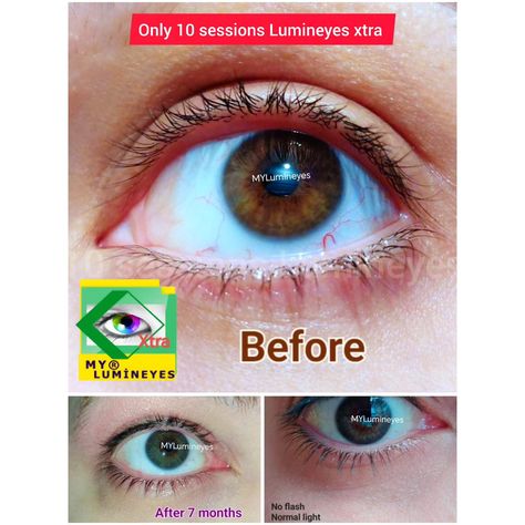 Laser eye color change surgery by Dr. Mustafa Mete = Lumineyes is the only safe and natural way to change your eye color from brown to green or blue naturally. #changingeyecolor #changeeyecolor #eyecolors #lasereyecolorchange #mylumineyes #lumineyes #drmustafamete #eyecolorchangelaser #blueeyes #browneyes #browntoblue #eyecolorchangesurgery #lighteningiris #lumineyesxtra https://mylumineyes.com/eye-color-change-surgery-cost-near-me-risks-of-laser/ Eye Color Change Surgery, Change Your Eye Color, Laser Eye, Healthy Eyes, Contact Lens, Eye Health, Eye Color, Blue Eyes, You Changed