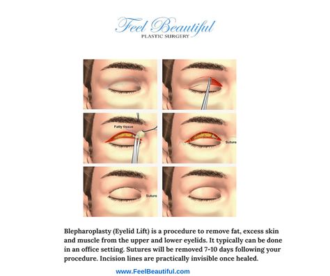 Eye Lid Surgery, Face Plastic Surgery, Plastic Surgery Fail, Upper Eyelid, Facial Plastic, Eye Surgery, Eye Lift, Lip Injections, Cosmetic Procedures