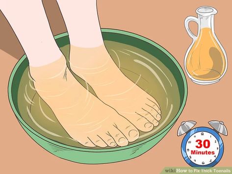 Curled Toenails, Curved Toenails, Brittle Toenails, Ugly Toenails, Toenail Problems, Yellow Toe Nails, Nail Discoloration, Nail Remedies, Nail Problems