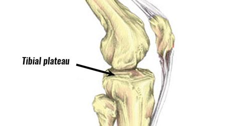 Physical Therapy for Tibial Plateau Fracture Recovery - Park Sports Physical Therapy - Brooklyn, NY Tibial Plateau Fracture, Knee Meniscus, Physiotherapy Exercises, Jumpers Knee, Sports Physical Therapy, Knee Ligaments, Rehabilitation Exercises, Kinesiology Taping, Knee Pain Relief