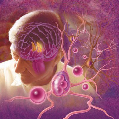 Illustration of Lewy bodies in Parkinson's Disease, by Mary K. Bryson. Explore more work by Mary K. Bryson on the Medical Illustration & Animation Sourcebook online site. #neuroscience #lewybodies #dementia #parkinsons #diseasemanagement #neurology #patienteducation #editorial #medical #illustration #medicalillustration #scientificillustration #medicalillustrator #sciart #medicaleducation #biology #science #scientific Animation Website, Science Artwork, Parkinsons Awareness, Lewy Body, Biology Science, Vascular Surgery, Mary K, Illustration Animation, Reconstructive Surgery