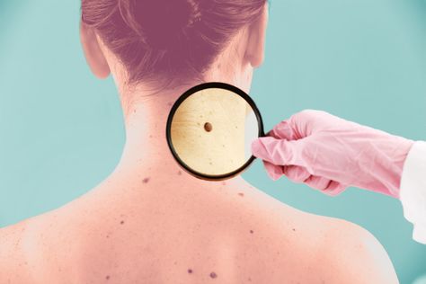 What Is a Cancerous Mole? Symptoms, Causes, and Treatments, Explained by Dermatologists Facial Mole, Cancerous Moles, Skin Moles, Type Of Skin, Squamous Cell, Types Of Surgery, Skin Growths, Fair Skin Tone, Layers Of Skin