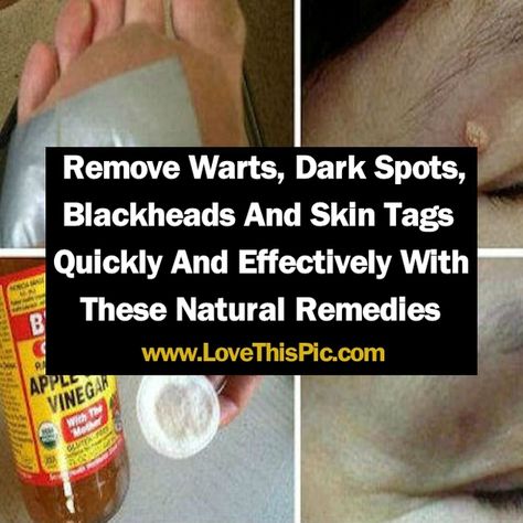 From time to time we all get affected by many skin disorders such as warts, moles. skin tags or dark spots. Fortunately, there are ways to get rid of them that are completely harmless, healthy and natural. Skin Tags Apple Cider Vinegar, Apple Cider Vinegar For Skin, Remove Warts, Korean Beauty Secrets, Skin Tags, Home Remedies For Hair, Beauty Diy, Beauty Remedies, Acne Remedies