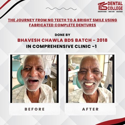 The Journey From No Teeth To A Bright Smile Using Fabricated Complete Denture, Done By Bhavesh Chawla BDS BATCH - 2018.
We wish you a great future ahead, and we are proud of you! @bhavesh_chawla09 ❤️
.
#itsdentalcollege #dentalcollege #dental #completedenture #denture #studentcase #student #dentistry #dentist #nirf #bestdentalcollege #brightsmile #smile Complete Denture Before And After, Complete Denture, Dental College, No Teeth, Greater Noida, Dentures, Bright Smile, Delhi Ncr, Proud Of You