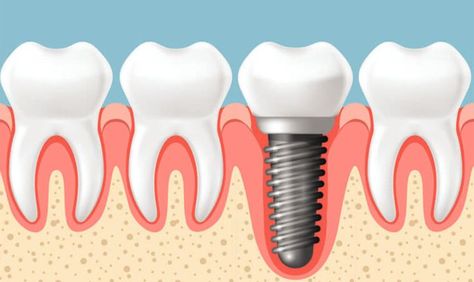 Dental Implant Cost Preparing For Surgery, Dental Implant Surgery, Dental Implants Cost, Dental Center, Dental Implant, Natural Teeth, Dental Office, Dental Implants, Dental Care