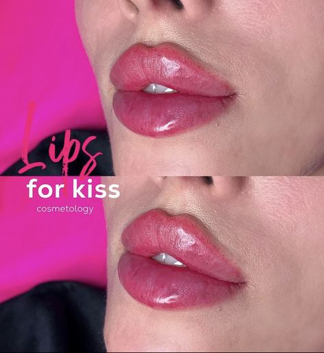 Butterfly Lip Filler, Russian Lips Filler, Desired Lips, Lip Fillers Juvederm, Russian Lips, Lips Inspiration, Face Fillers, Botox Lips, Face Surgery