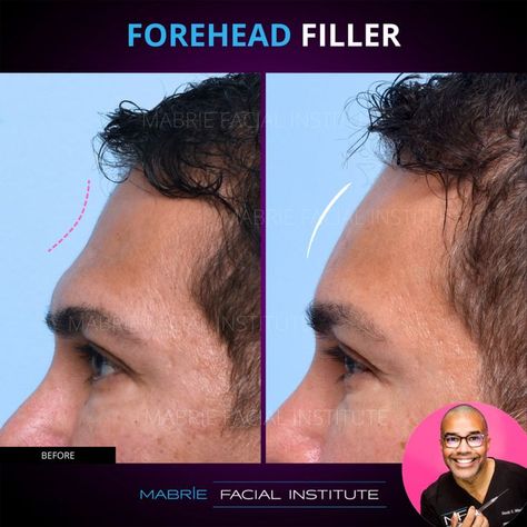 Filler can be used to #rejuvenate & improve the shape of the forehead. Concavity can occur at the temples and above the brow - most noticeable on profile and 3/4 view.  Forehead shape can also be hereditary. 

How will he benefit from #foreheadshaping?👍
It smooths bumps and fills-out any hollows and indentations. Dermal fillers like #lyft are great when combined with neuromodulators like #BOTOX & #Dysport

Results achieved in 2 visits.
Maintenance: 1x year. Forehead Filler Before And After, Forehead Filler, Downtown San Francisco, Ancient Chinese Dress, Facial Rejuvenation, Before After Photo, Dermal Fillers, After Photos, San Francisco Bay