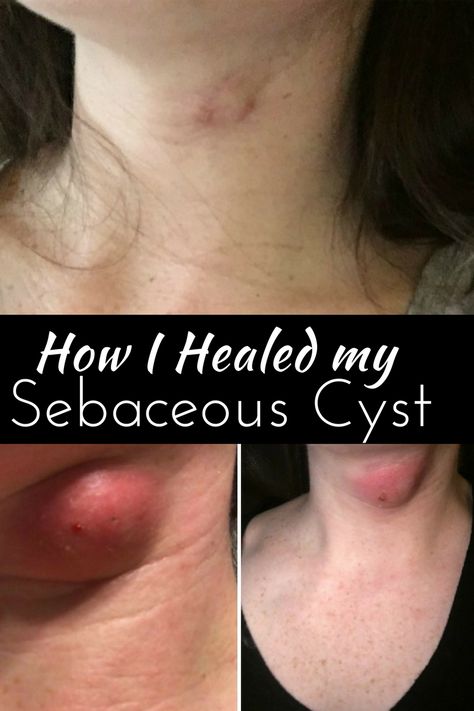 How I Healed my Sebaceous Cyst Essential Oils For Cysts, Home Remedies For Cysts, I Healed, Growing Healthy Hair, Pimples Remedies, Healthy Diet Tips, Young Living Oils, Health Skin Care, Natural Remedies