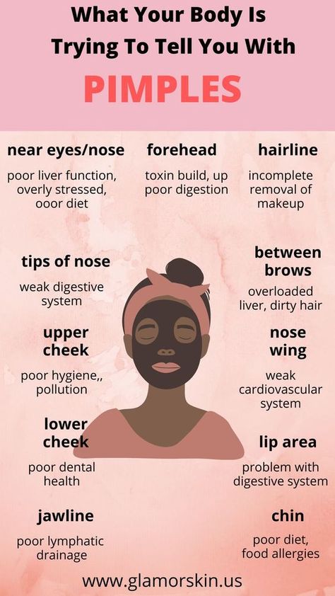 What Your Pimples Are Telling You, Pimple Prevention Tips, How To Remove Acne And Pimples, To Get Rid Of Pimples, How Do You Get Rid Of A Pimple Overnight, How To Not Get Pimples, Tips To Prevent Acne, How To Get Rid Of Pimples Under The Skin, How To Remove A Pimple Overnight