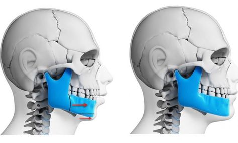 Corrective Jaw Surgery, Double Jaw Surgery, Mouth Breathing, Impacted Tooth, Orthognathic Surgery, Implant Dentist, Orthodontic Appliances, Cleft Palate, Jaw Surgery