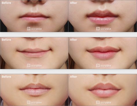 Plastic Surgery Korea, Lip Surgery, Korean Plastic Surgery, Heart Shaped Lips, Korean Lips, Lip Augmentation, Lip Hair, Plastic Surgery, Surgery