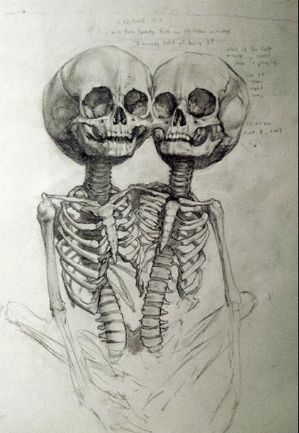 conjoined twins, grotesque yet beautiful Skeleton Anatomy, Human Oddities, Conjoined Twins, Skeleton Illustration, Skeleton Tattoos, Skeleton Art, Scientific Illustration, Medical Illustration, Anatomy Art