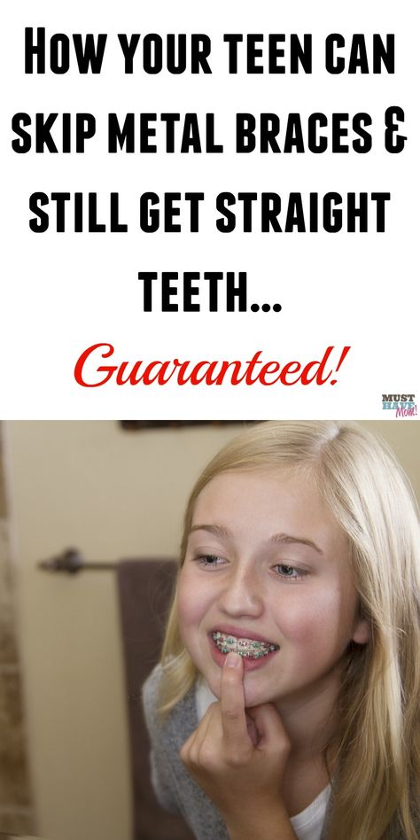 How To Get Straight Teeth Naturally, How To Get Straight Teeth Without Braces, How To Get Straight Teeth, Tips For Getting Braces Off, Crooked Teeth Aesthetic, Food To Avoid With Braces, What To Expect When Getting Braces, Straight Teeth Without Braces, Straighten Teeth Without Braces