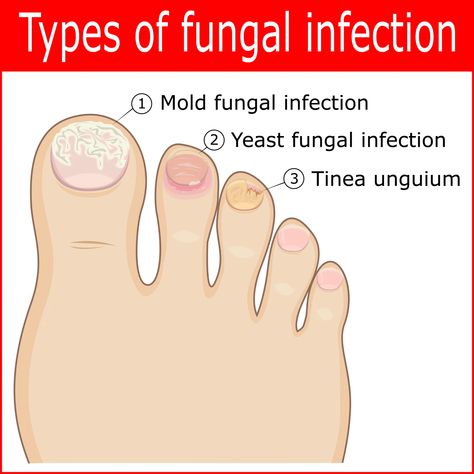 Blog 20 - What Kills Toenail Fungus Instantly? Toenail Pain, Infected Toenail, Toenail Fungal Infection, Nail Falling Off, Fingernail Fungus, Nail Infection, Fungal Nail, Ingrown Toe Nail, Toenail Fungus