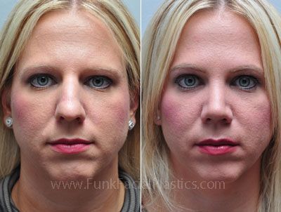 Bulbous Tip Rhinoplasty, Bulbous Nose Rhinoplasty Before After, Bulbous Nose Rhinoplasty, Nose Rhinoplasty, Slim Nose, Nose Tip, Bulbous Nose, Nose Jobs, Rhinoplasty Before And After