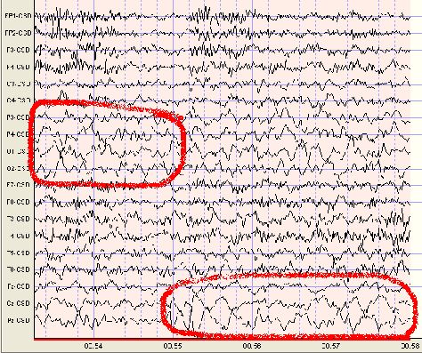 Delta waves are slow EEG waves that oscillate from about .5 to 4 times per second. Delta should generally be absent from the waking EEG records of adults. Focal Delta may be the result of a lesion or tumor or may indicate damage from a stroke. Delta Waves, Brain Mapping, Brain Waves, Night Shift, Brain, Candy