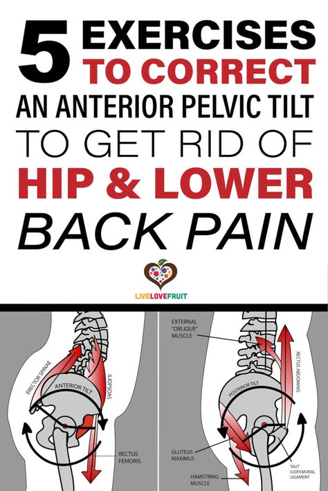 graphic anatomical representation of anterior pelvic tilt with text - 5 exercises to correct an anterior pelvic tilt to get rid of hip & lower back pain Anterior Pelvic Tilt, K Tape, Hip Flexor Exercises, Hip Pain Relief, Pelvic Tilt, Lower Back Pain Exercises, Posture Exercises, Relieve Back Pain, Back Pain Exercises