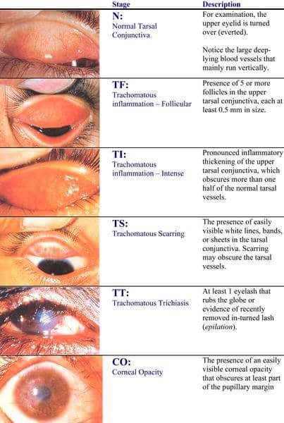 Contagiousness and Survival of the Chlamydia trachomatis Bacterium - Medical Sciences Stack Exchange Eye Facts, Eye Anatomy, Eye Infections, Eyes Problems, Eye Doctor, Medical Science, Dry Eyes, Eye Health, Blood Vessels