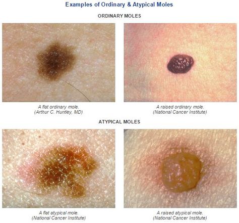 The first step in learning about melanoma is to learn about moles.  The first step in learning about melanoma is to learn about moles, common pigmented skin lesions that can be flat or raised. There are two types of moles: ordinary and atypical (the medical term for atypical moles is dysplastic nevi). 10 to 15 percent of the white population have atypical moles.  http://www.skincheck.org/Page2.php#moles  #MelanomaEducation #melanoma #moles Mole Meaning, Wart On Finger, Pigmented Skin, Skin Lesions, Red Moles, Remove Skin Tags Naturally, Skin Moles, Natural Face Cleanser, Improve Nutrition