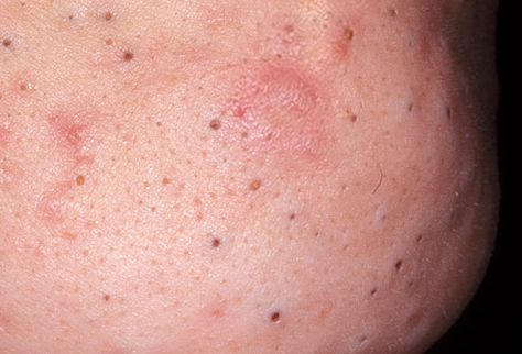 Close up of blackheads Blackheads On Cheeks, Squeezing Blackheads, Blackheads On Face, Different Types Of Acne, Blackheads On Nose, Visual Dictionary, Types Of Acne, How To Get Rid Of Pimples, Get Rid Of Blackheads