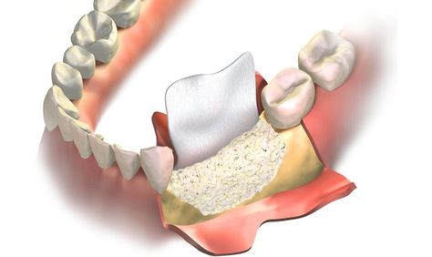 Suffering from bone deficiency but want to get your Implants for a beautiful smile transformation? Then visit our office, in Cypress, TX for Bone Grafting! Types Of Bones, Oral Maxillofacial, Bone Grafting, Oral Surgeon, Tooth Replacement, Tooth Extraction, Bone Loss, Jaw Bone, Natural Teeth