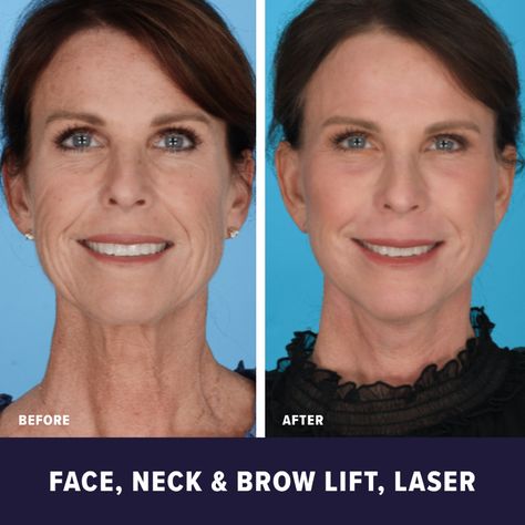 This patient of got a facelift, neck lift, brow lift, erbium laser resurfacing, and facial transfer, and is shown here two months post-op looking utterly rejuvenated and even-toned. ✨ Erbium Laser, Laser Resurfacing, Neck Lift, Brow Lift, Post Op, Plastic Surgeon, Plastic Surgery, Facial, Beauty