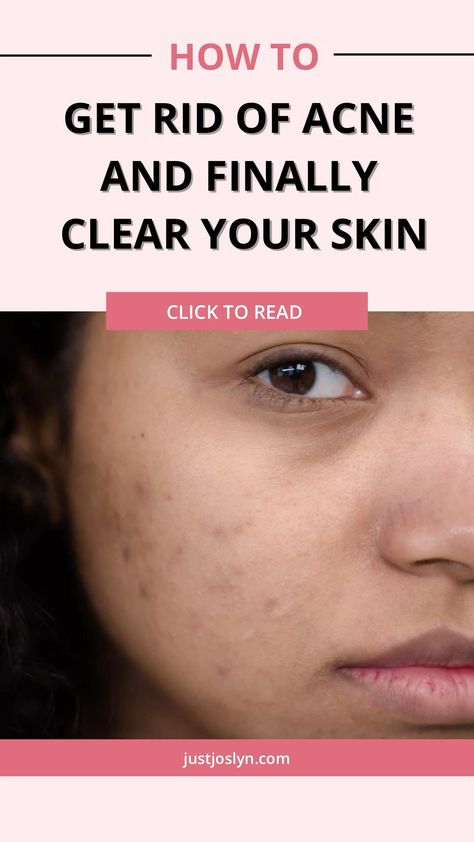 How To Get Rid Of Acne and Get Clear Skin:   Skincare Tips For Acne-Prone Skin Tips For Clear Skin, Under Eye Lines, Pimple Solution, Regular Skin Care Routine, Teenage Acne, Clear Your Skin, Get Rid Of Pimples, Rid Of Pimples, Get Clear Skin