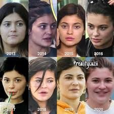 Why Fillers Are The Go-To Beauty Hack For Millennials Kylie Before Surgery, Kylie Jenner No Makeup, Body Surgery, Kylie Jenner Makeup, Brow Lift, No Makeup, Look Older, Natural Face, Sagging Skin