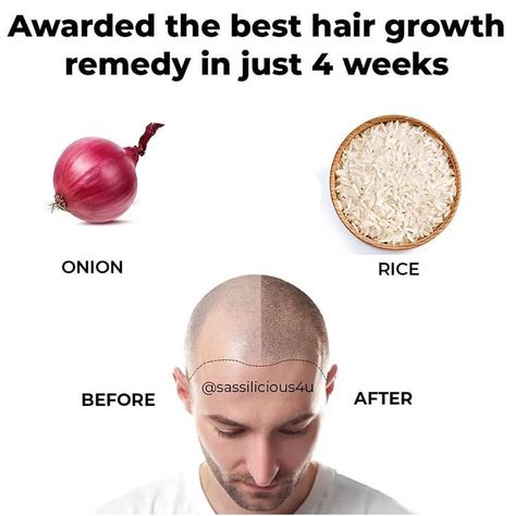 Hair Growth Foods, Facial Tips, Hair Remedies For Growth, Boost Hair Growth, Hair Remedies, Natural Health Remedies, Hair Fall, Health And Beauty Tips, Grow Hair