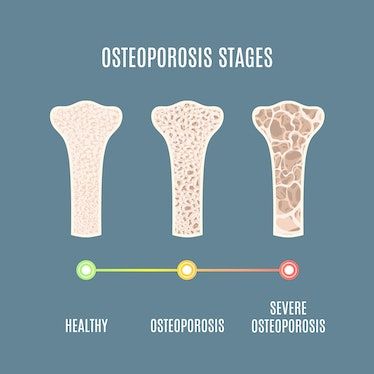 Osteoporosis Symptoms, Hip Fracture, Foot Reflexology Massage, Bone Fracture, Bone Diseases, Calcium Supplements, Reflexology Massage, Foot Reflexology, Bone Loss