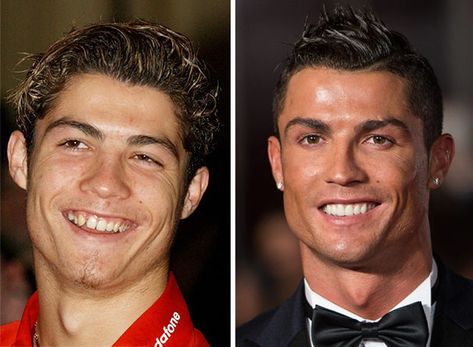 Cristiano Ronaldo Before And After Braces Celebrity Teeth, Braces Before And After, Kawat Gigi, Bad Celebrity Plastic Surgery, After Braces, Dental Braces, Perfect Teeth, Teeth Braces, Celebrity Plastic Surgery