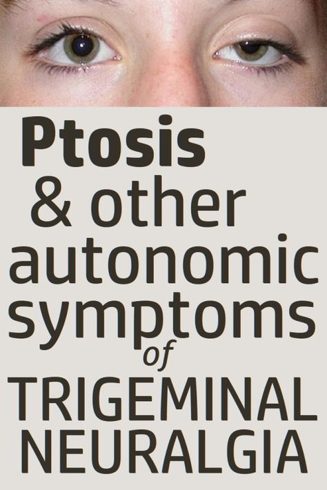 Glossopharyngeal Neuralgia, Nerve Pain Remedies, Occipital Neuralgia, Itchy Ears, Local Cafe, Forward Head Posture, Chiari Malformation, Nerve Health, Facial Nerve