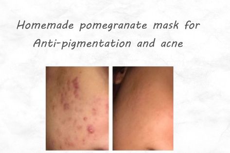 Skincare Clear Skin, Hyperpigmentation Mask, Forehead Bumps, Clear Skin Care, Fungal Acne, Acne Skincare, Summer Skin, How To Get Rid Of Acne, Glowy Skin