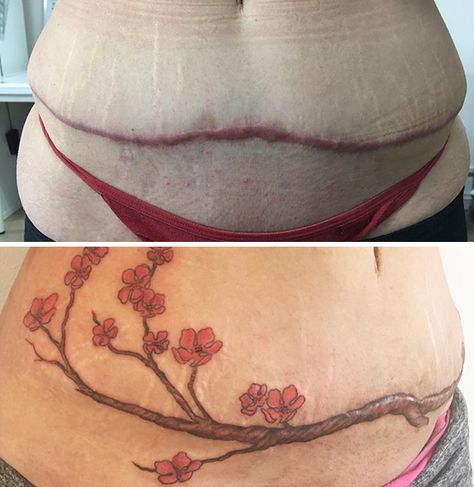 10+ Amazing Tattoos That Turn Scars Into Works Of Art C Section Scar Tattoo, Abdomen Tattoo, Tummy Tattoo, Tattoo Over Scar, Mastectomy Tattoo, Scar Cover Up, Tattoos To Cover Scars, Scar Tattoo, Tattoo Cover Up