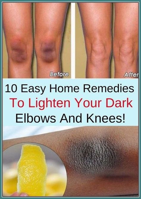 DIY remedies for dark underarms How To Lighten Knees, Dark Elbows And Knees, Dark Spots On Legs, Sunburn Peeling, Dark Elbows, Constant Headaches, Natural Face Care, Dark Underarms, Perfect Skin Care Routine