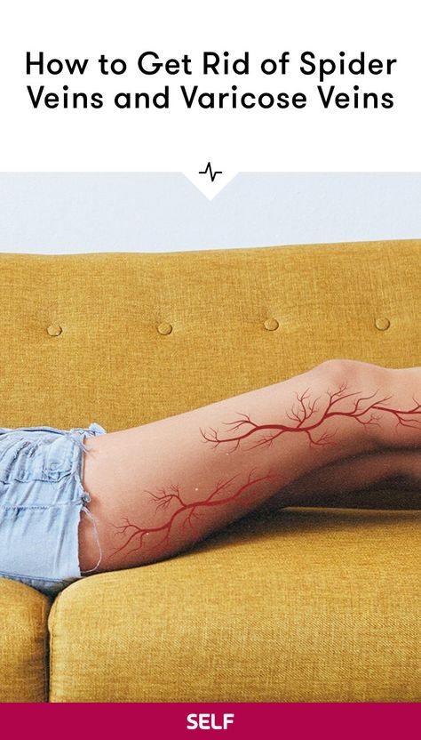 Vericous Veins, Home Remedies For Spiders, Varicose Vein Remedy, Visible Veins, Leg Veins, Red Veins, Muscle Aches, Blood Vessels, Get Healthy