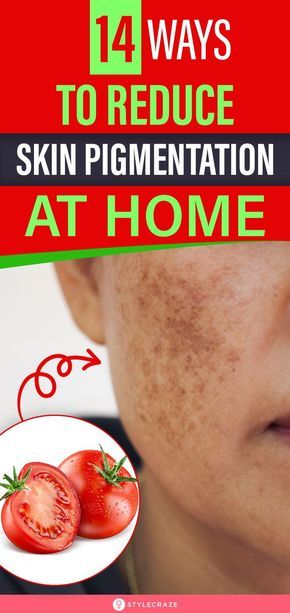 Pigmentation Remedy, Home Remedies For Face, Home Remedies For Bronchitis, Home Remedies For Skin, Dry Skin Remedies, Skin Pigmentation, Spots On Face, Ingrown Toe Nail, Younger Looking Skin