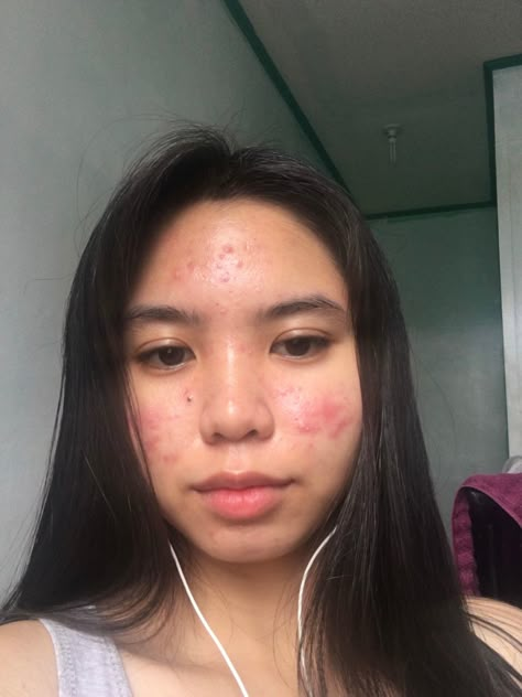 Normalize Acne, Acne Appreciation, Strawberry Freckles, Acne Positive, Acne Photos, Acne Awareness, Girl With Acne, Acne Positivity, People With Acne