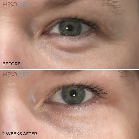 👀 Seeing is believing! Say goodbye to fine lines and hello to refreshed, youthful eyes. Our Eye Renewal duo is the secret to smoother lids, brighter under-eyes, and a look that radiates confidence. ✨ This gorgeous before and after was taken two weeks apart ✨ Let the results speak for themselves. Shop now at MesoLyft.com #MesoLyft #eyecare #skincare #antiaging #eyecream #serum #beforeandafter #transformation #radianteyes #youthfuleyes #skincareroutine Seeing Is Believing, Eye Roller, Flawless Makeup Application, Under Eyes, Aging Serum, Prevent Aging, Under Eye Concealer, Derma Roller, Skin Complexion