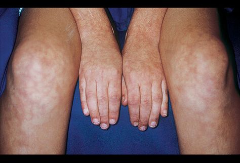 Picture of Livedo Reticularis Livedo Reticularis, Best Hair Vitamins, Autonomic Nervous System, Autoimmune Disorder, Hair Vitamins, Skin Diseases, Invisible Illness, Autoimmune Disease, Dermatology