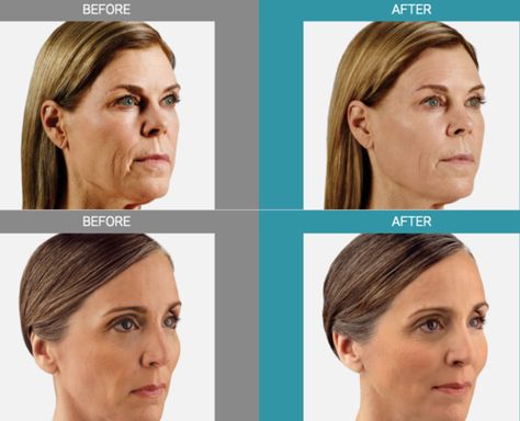 Check out Juvederm before and after photos. Juvederm Before And After, Before And After Pics, Stay Young, After Photos, Winter Garden, Plastic Surgery, Surgery, Hair, Beauty