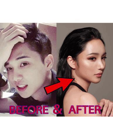 Ffs Surgery, Linda Tran, Facial Contouring, Transgender Mtf, Female Transformation, Cosmetic Surgery, Plastic Surgery, Korean Beauty, Surgery