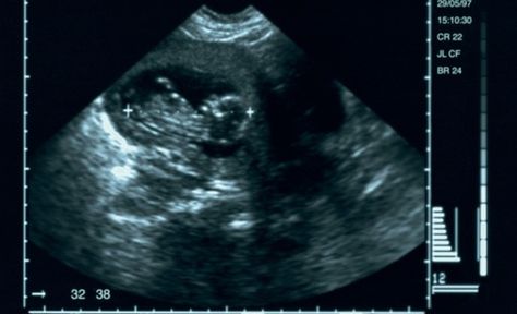 Does Looking at the Ultrasound Before an Abortion Change Women's Minds? 6 Weeks Pregnant Ultrasound, 6 Weeks Pregnant, First Ultrasound, Gestational Age, In Vitro Fertilization, Ground Breaking, Weeks Pregnant, Pregnancy Test, Pregnancy Week By Week