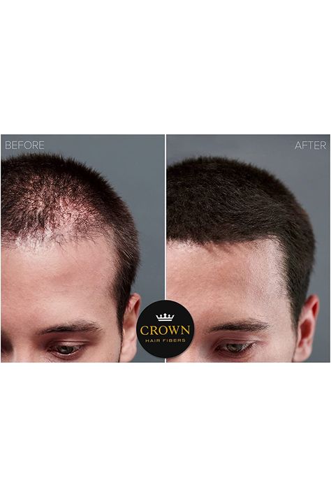 Hair Dark Brown, Hair For Men, Bald Patches, Bald Spot, Crown Hair, Bald Hair, Hair Dark, Keratin Hair, Hair Starting