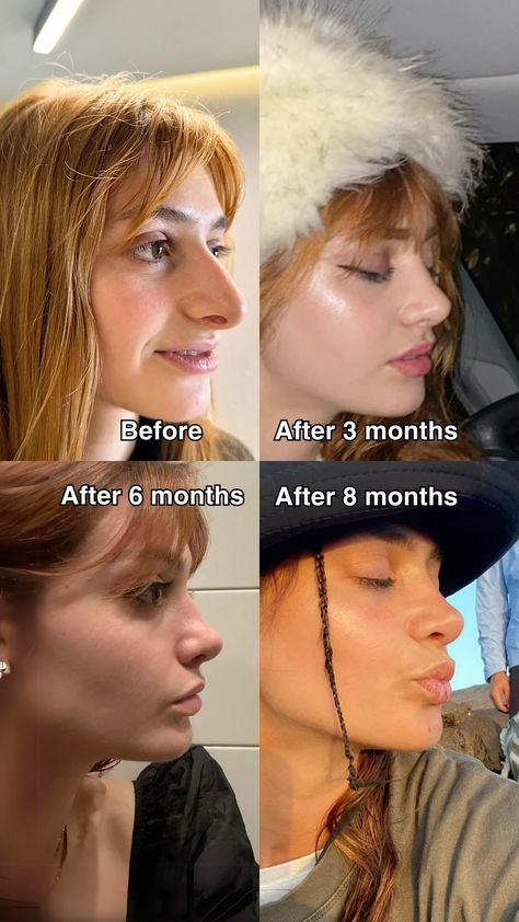 Rhinoplasty Healing Process 🏥✨  First Week: Expect swelling and bruising. This is completely normal! 👀 Weeks 2-4: Swelling begins to subside, and you’ll start seeing improvements. 🌼 Months 1-6: Continued healing, with noticeable changes emerging. 📆 Final Results: It can take up to a year for complete results to appear. Patience is key! ⏳ 💡 Tip: Follow your surgeon's aftercare instructions for the best outcome!  #rhinoplasty #nosejob #barbienose Long Nose Rhinoplasty Before And After, Nose Job Before And After Rhinoplasty, Nose Job Before And After, Nosejob Rhinoplasty Before After, Rhinoplasty Recovery Tips, Rhinoplasty Bulbous Nose, Rhinoplasty Recovery Timeline, Revision Rhinoplasty, Thick Skin Bulbous Tip Rhinoplasty