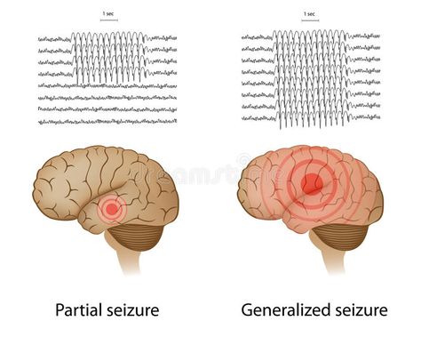 Status Epilepticus, Seizures Awareness, First Aid Tips, Neurological Disorders, Nursing Notes, Pediatric Nursing, Fascinating Facts, Brain Activities, Neurology