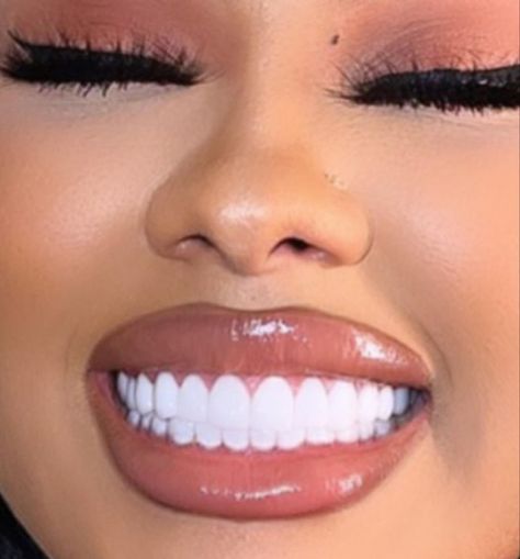 Perfect Teeth Smile, Naturally Whiten Teeth, Loose Teeth, Teeth Aesthetic, Glossy Lips Makeup, Pretty Teeth, Composite Veneers, Veneers Teeth, Beautiful Teeth